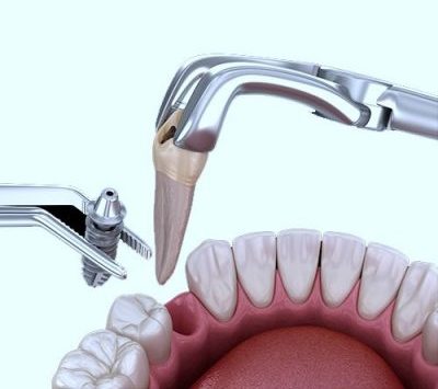 Dental implant process illustration.