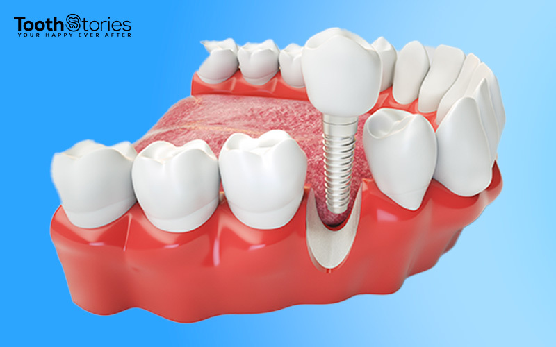 image of dental implant 