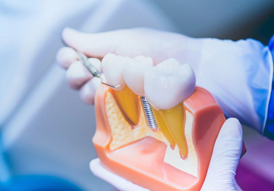 dental implant shown in 3d model