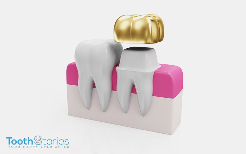 Dental Crowns-Quick Tooth Replacement