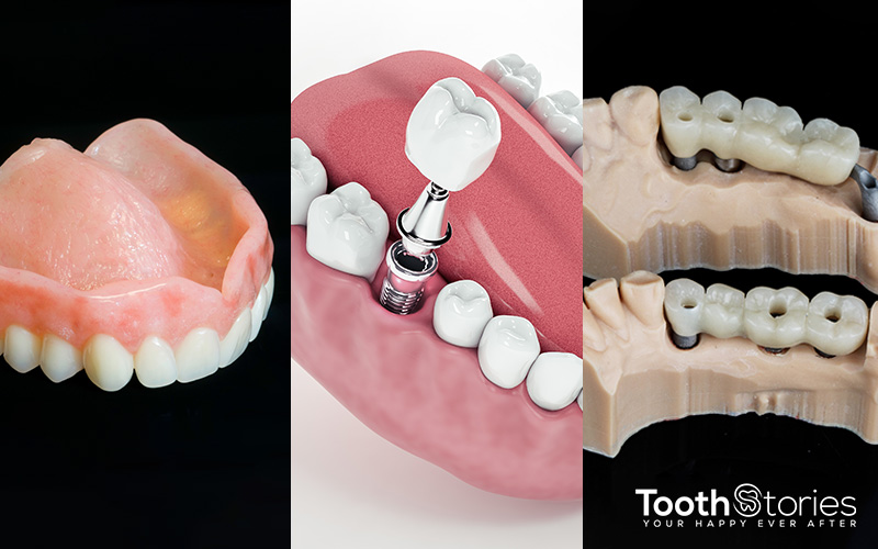 Choosing a tooth replacement