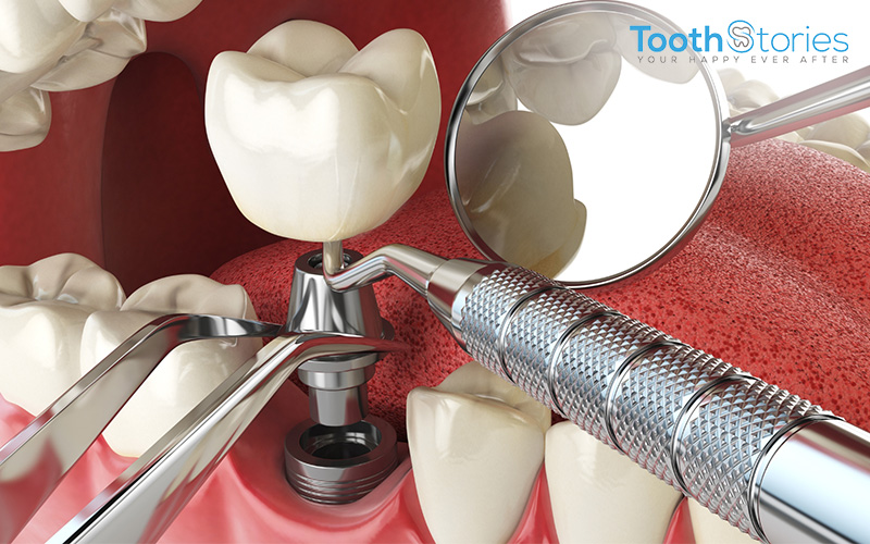 dental implant shown with equipments