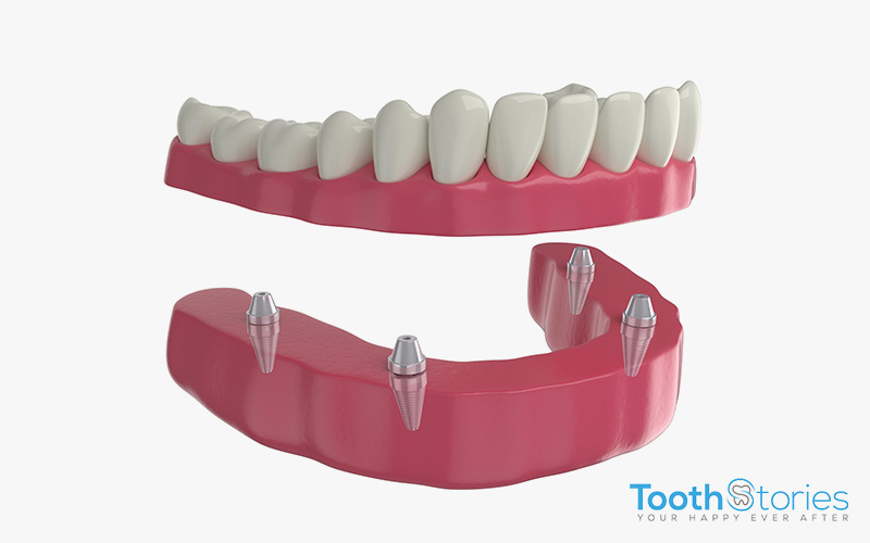 Implant-Supported Dentures