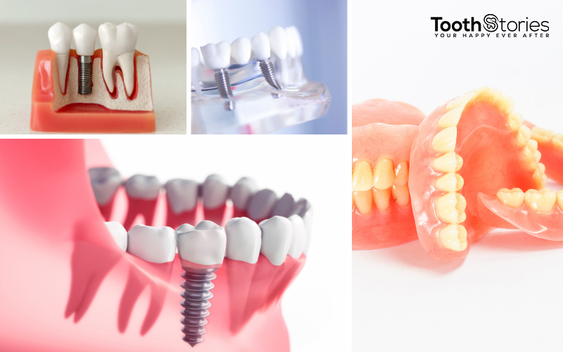 Dental Implants vs Dentures Which Should You Choose?