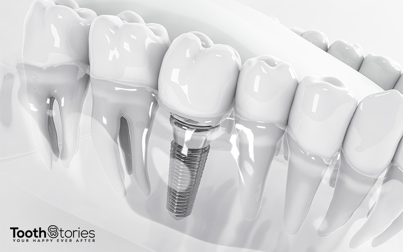 What are Dental Implants?-Dental Implants Singapore