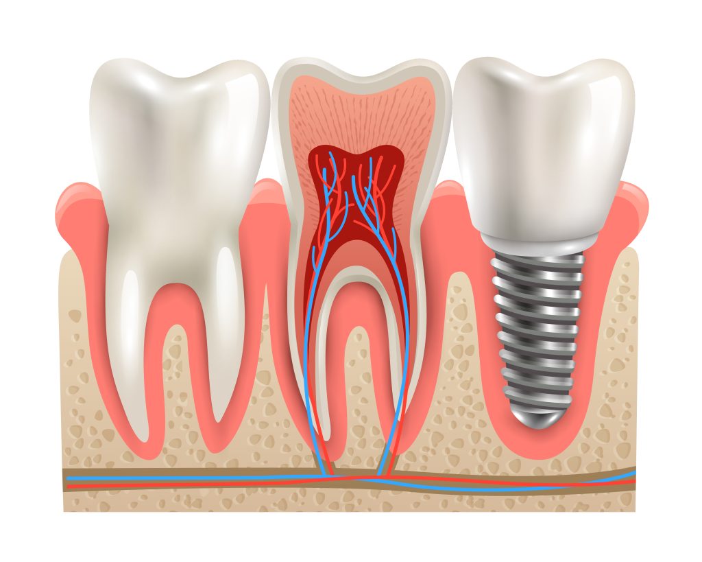 Dental Implants Anatomy Closeup Model