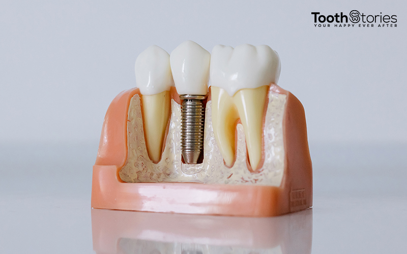 A Dental Implant Procedure