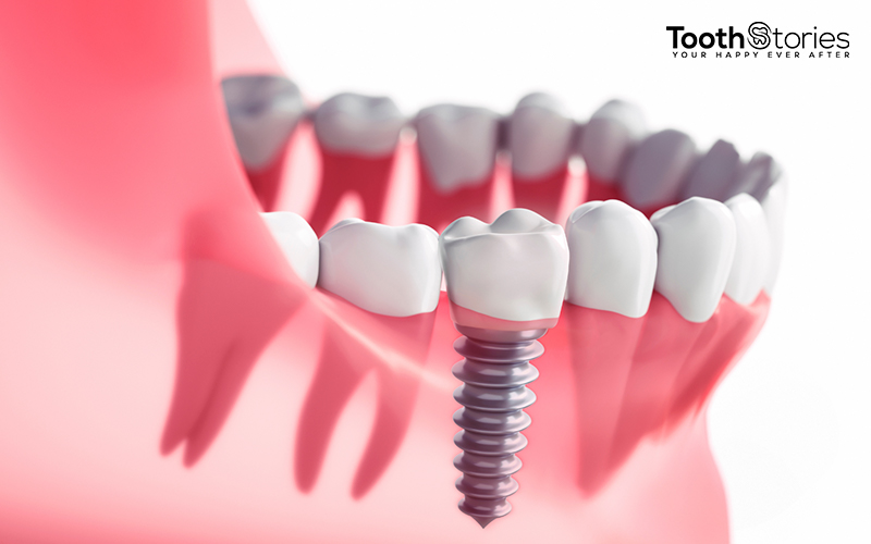 Types of dental implants: which is suitable for you?