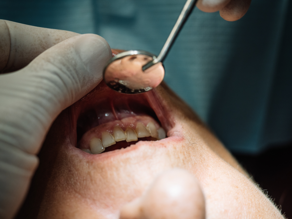 cracked tooth repair singapore