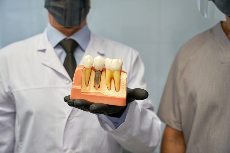 Why Choose Dental Implants Over Bridges? A Comparative Look Tooth Stories